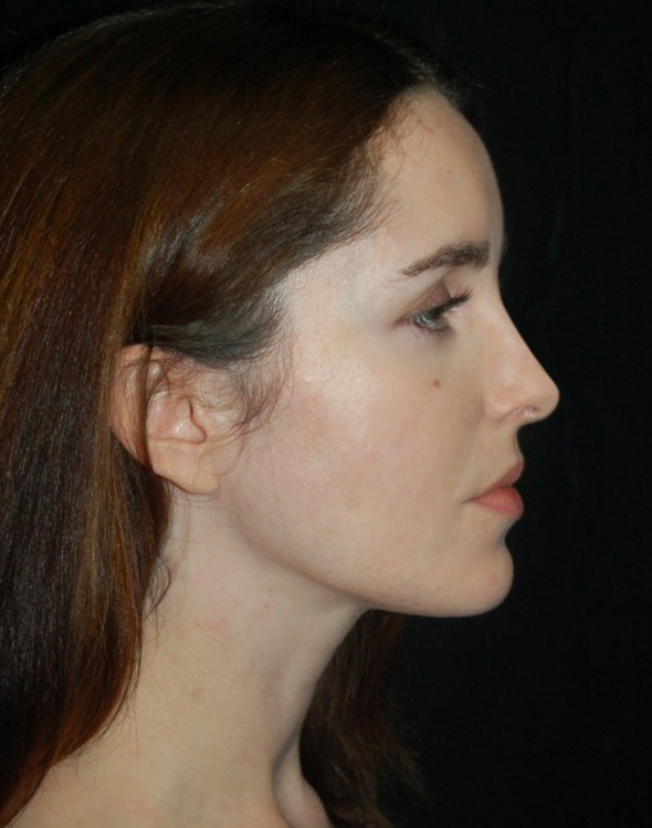 After thumbnail for Case 50 Rhinoplasty Before and After Photos