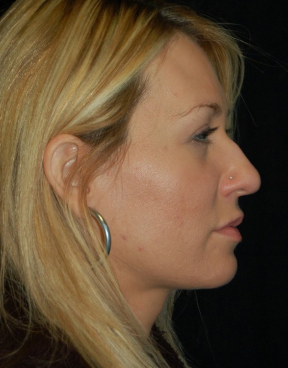 Before thumbnail for Case 52 Rhinoplasty Before and After Photos