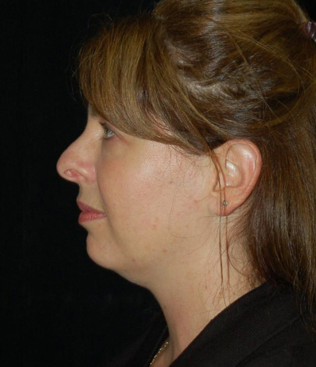 Before thumbnail for Case 65 Rhinoplasty Before and After Photos