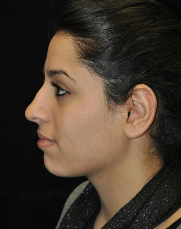 Before thumbnail for Case 99 Rhinoplasty Before and After Photos