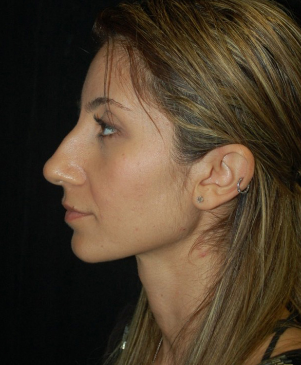 Before thumbnail for Case 85 Rhinoplasty Before and After Photos