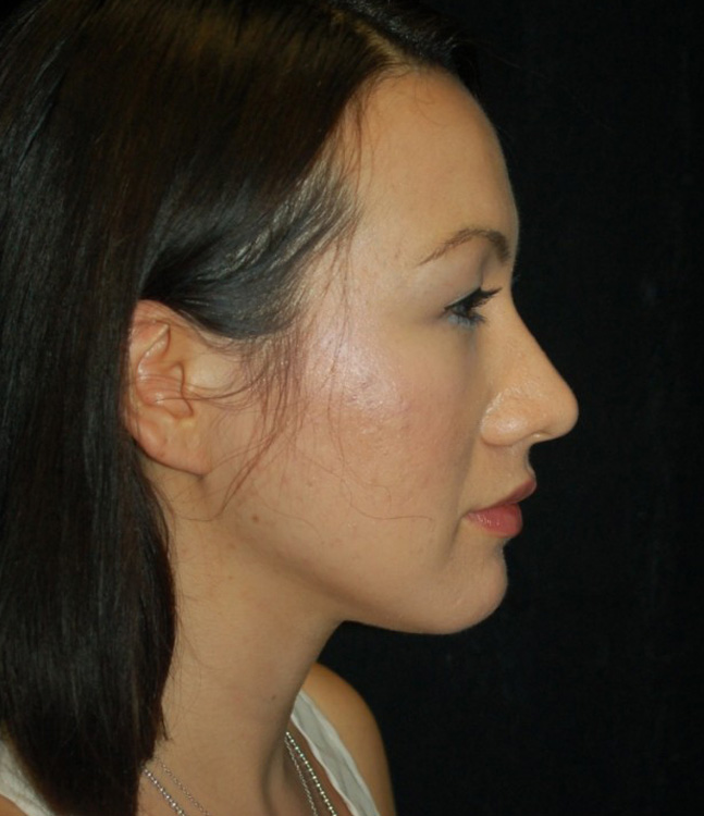 Before thumbnail for Case 84 Rhinoplasty Before and After Photos