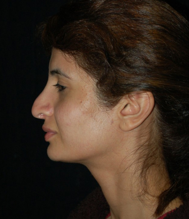 Before thumbnail for Case 3 Rhinoplasty Revision Before and After Photos