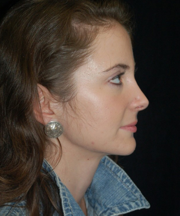 After thumbnail for Case 4 Rhinoplasty Revision Before and After Photos