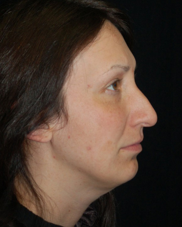 Before thumbnail for Case 9 Rhinoplasty Revision Before and After Photos