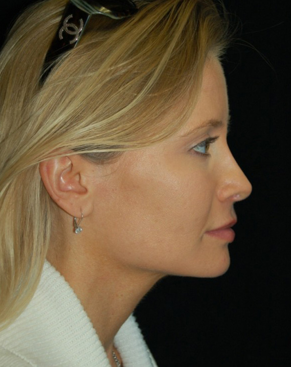 After thumbnail for Case 12 Rhinoplasty Revision Before and After Photos