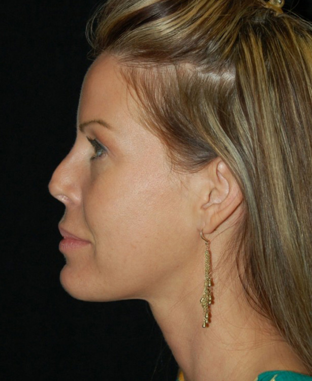 Before thumbnail for Case 14 Rhinoplasty Revision Before and After Photos