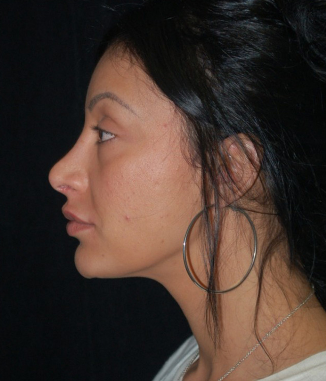 Before thumbnail for Case 15 Rhinoplasty Revision Before and After Photos