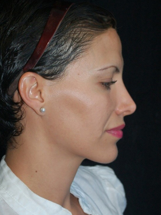 After thumbnail for Case 17 Rhinoplasty Revision Before and After Photos
