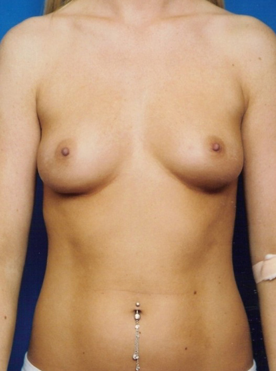 Before thumbnail for Case 10 Breast Augmentation Before and After Photos
