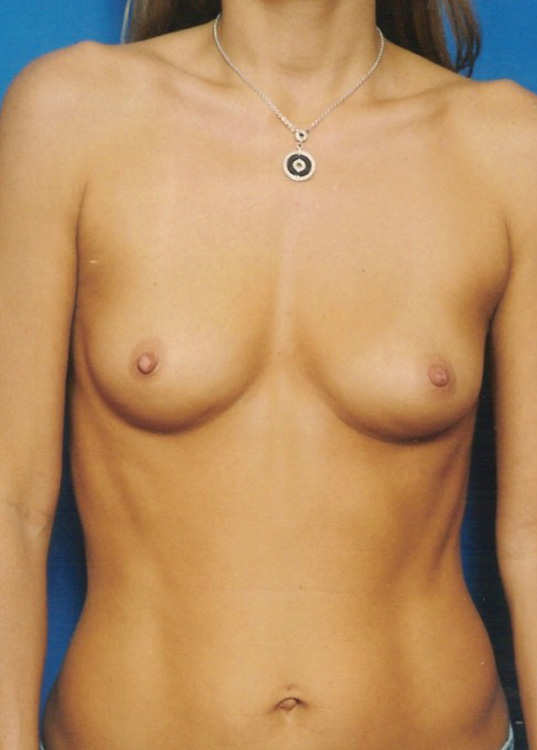 Before thumbnail for Case 12 Breast Augmentation Before and After Photos
