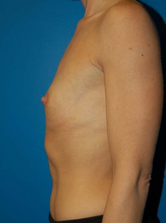 Before thumbnail for Case 16 Breast Augmentation Before and After Photos