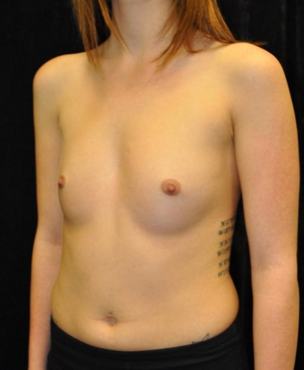 Before thumbnail for Case 17 Breast Augmentation Before and After Photos