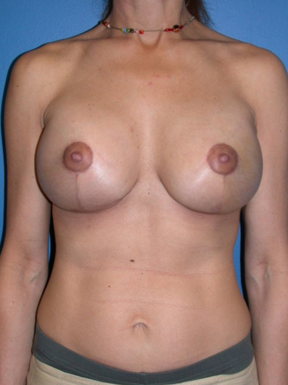 After thumbnail for Case 2 Breast Augmentation with Full Lift Before and After Photos