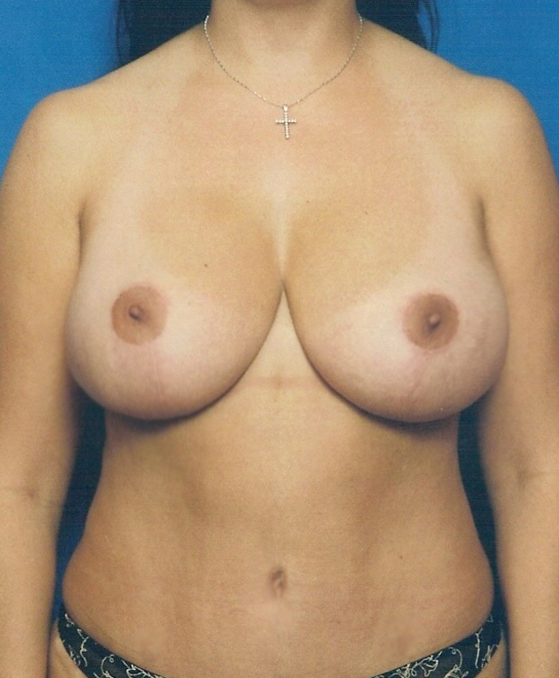 After thumbnail for Case 1 Breast Lift Before and After Photos