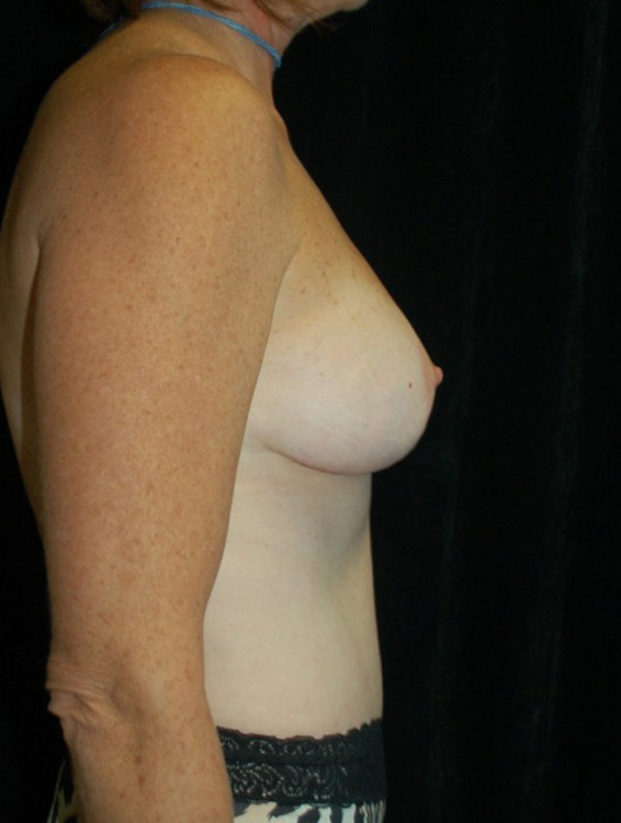 After thumbnail for Case 7 Breast Lift Before and After Photos